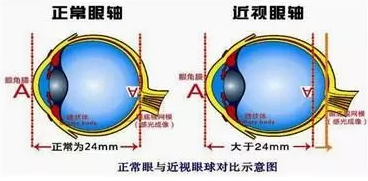 近視眼球突出？！控制近視度數(shù)加深是關(guān)鍵！
